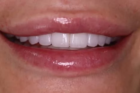 Best Veneers by Dr. Joseph Goodman
