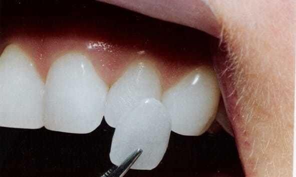 veneers-article (01)