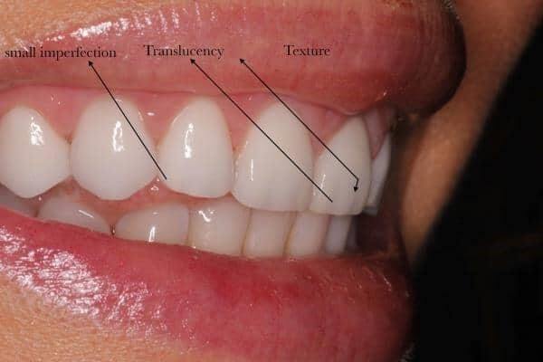 veneers-article (10.9)