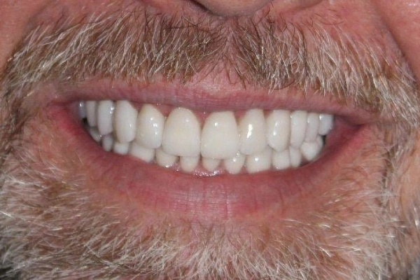 veneers-article (11) (1)