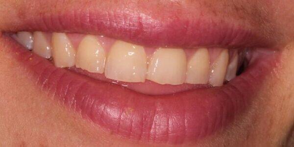 veneers-article (12)
