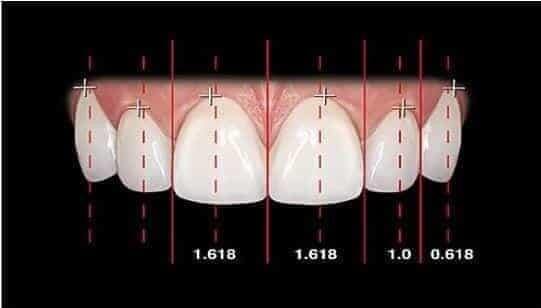 veneers-article (20)