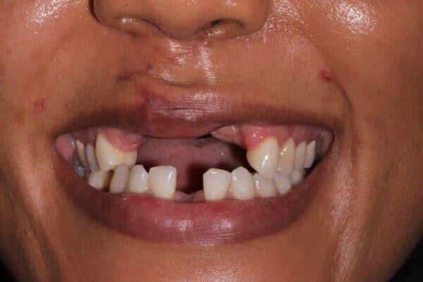 veneers-article (21)