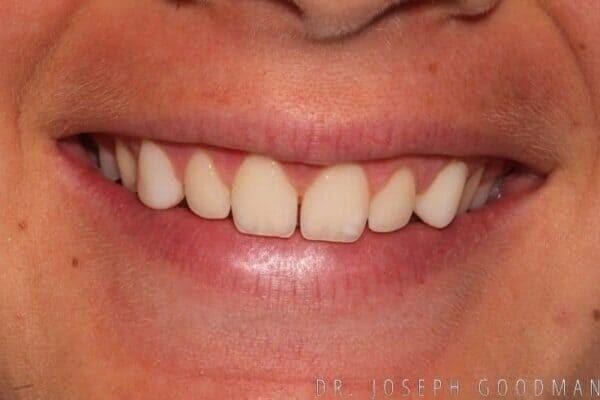 veneers-article (23)