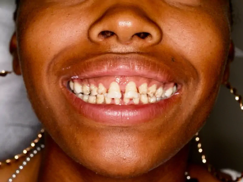 Tyrica Smile Makeover - Before Picture with Baby Teeth