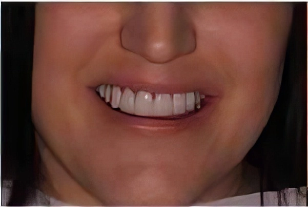 bad-veneers-01-topaz Bad Veneers 01