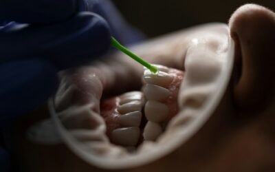 What to Do in a Dental Emergency