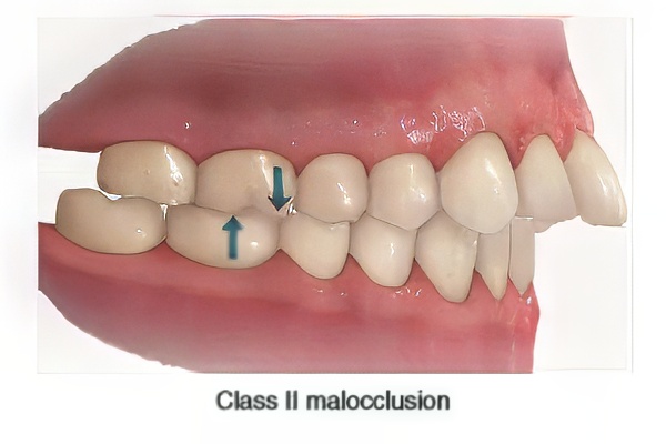Class-II-Malocclusion-Bite Class II Malocclusion Bite