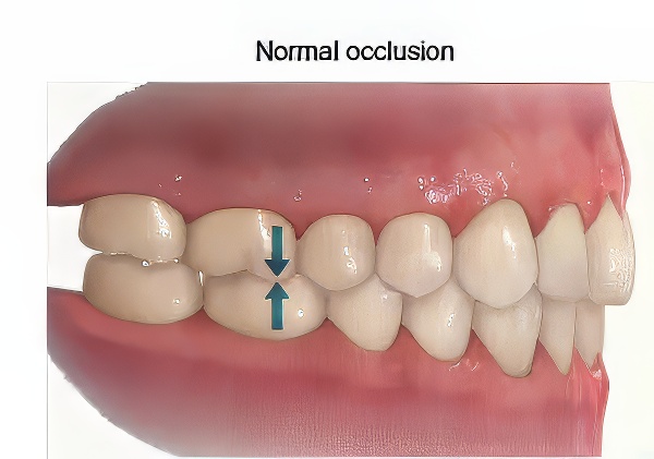 Normal-Occlusion-Class-I-Bite Class II Malocclusion Bite