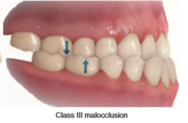 class-iii-malocclusion class-iii-malocclusion