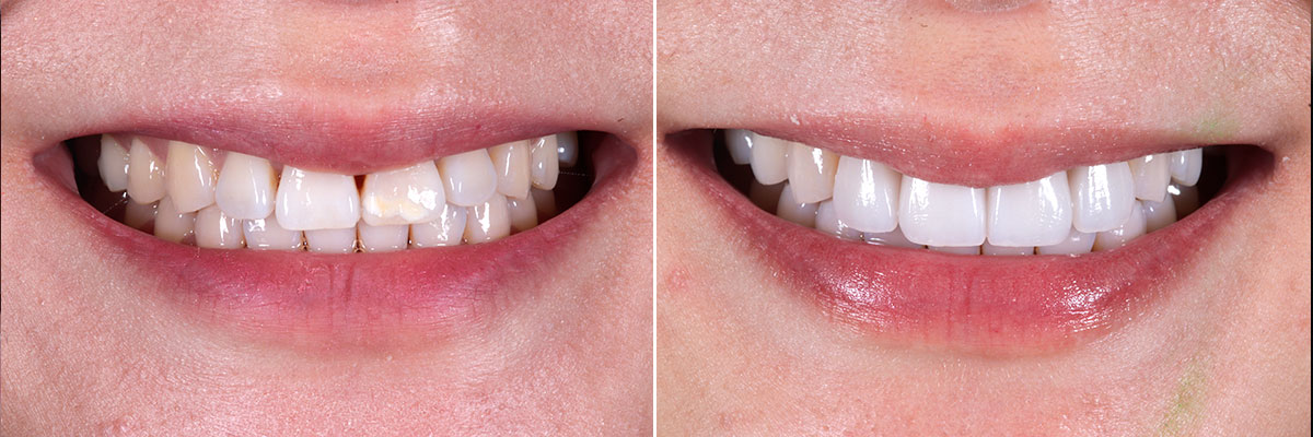 Perfect Hollywood Smile