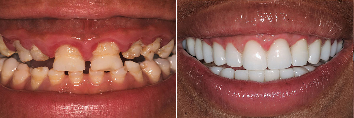 Perfect Hollywood Smile