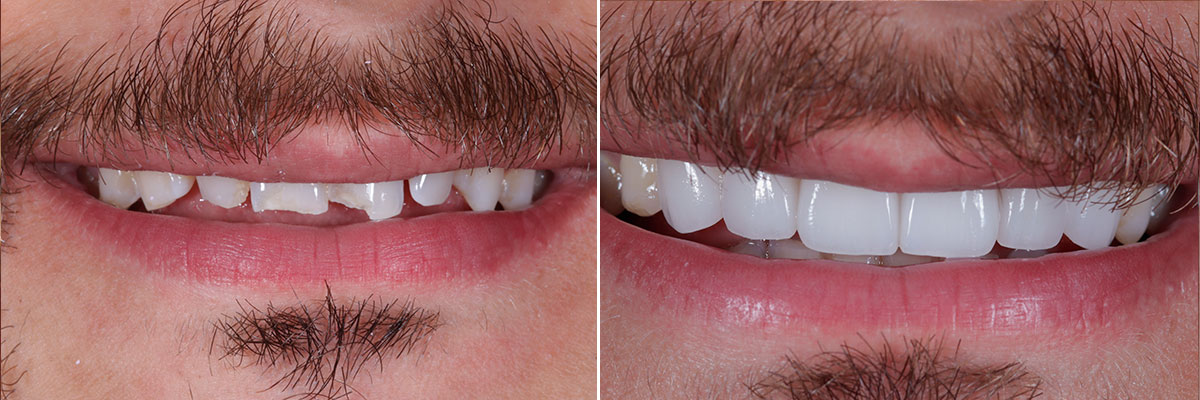 Perfect Hollywood Smile