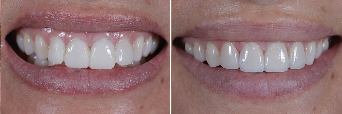 Perfect Hollywood Smile