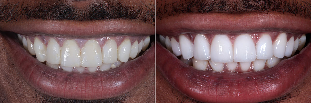 Perfect Hollywood Smile