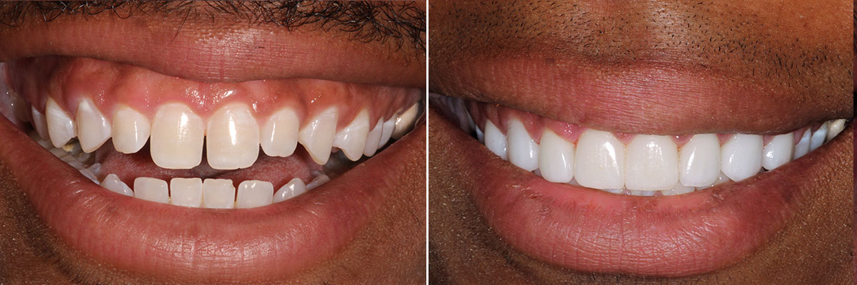 Perfect Hollywood Smile