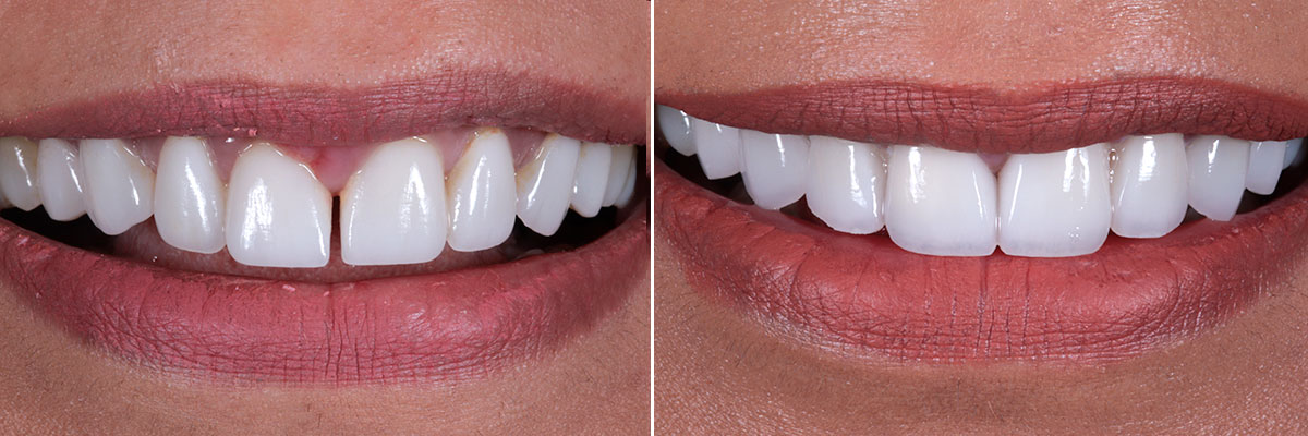 Perfect Hollywood Smile