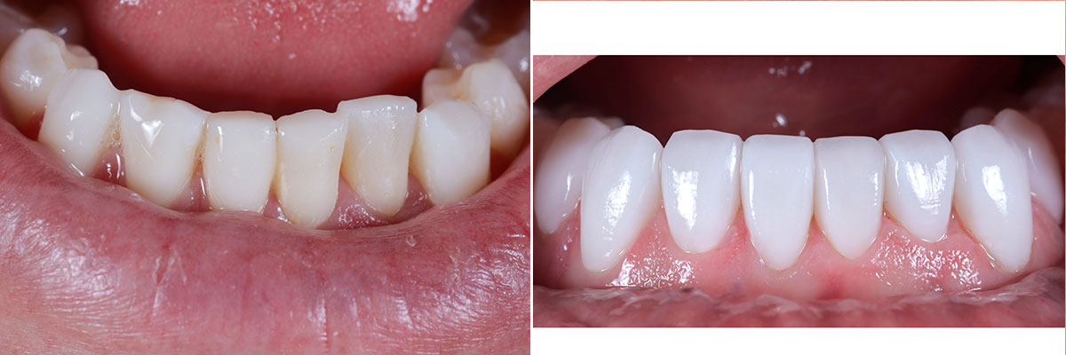 0031-l1-l2 Veneers on Lower Teeth