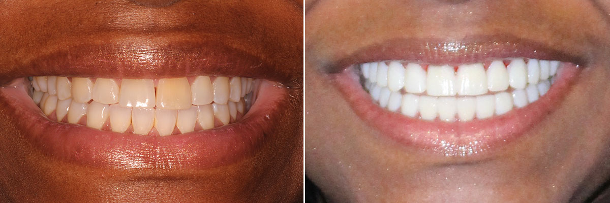 0038-texas-smile-makeover Smile Makeover from Texas