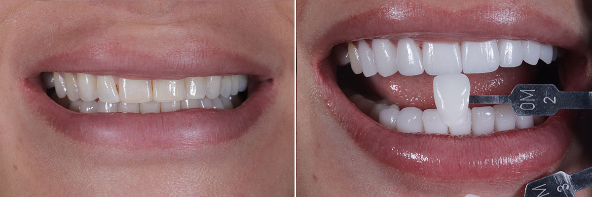 033-smile-makeover Full Mouth Veneers