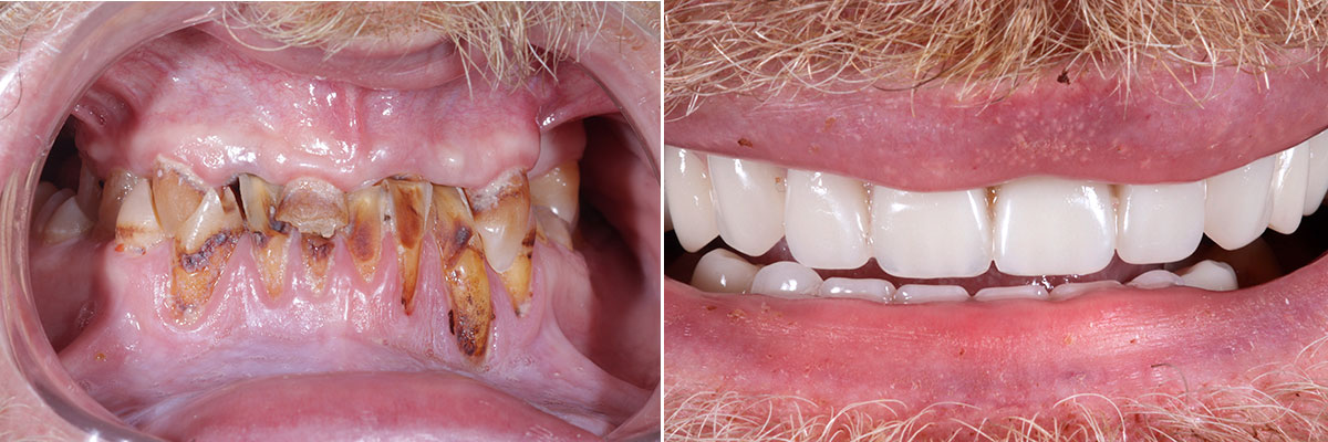 034-implants Full Mouth Reconstruction
