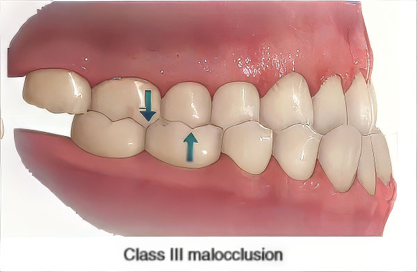 Class-III-Malocclusion Class-III-Malocclusion