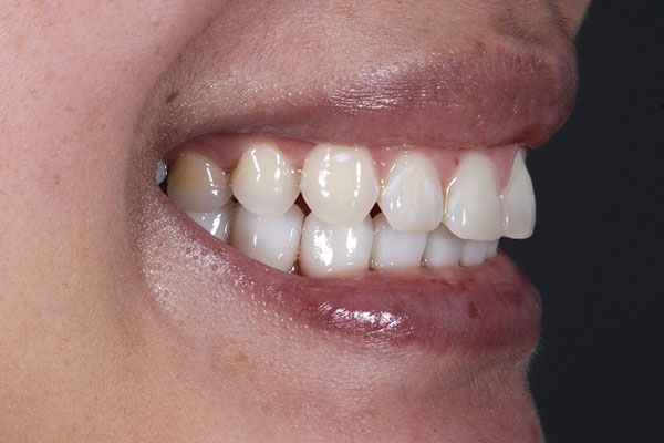 aft-overjet-correction After Overjet Correction