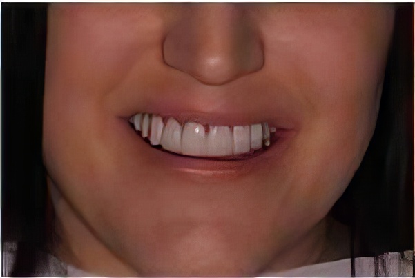 bad-veneers-01-topaz Bad Veneers 01