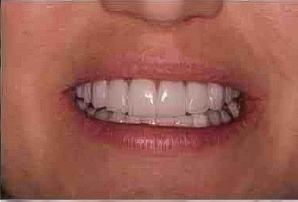 bad-veneers-02-topaz Bad Veneers 02