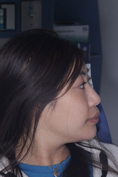 bef-bitetrac-jaw-alignment Before Facial Profile Correction