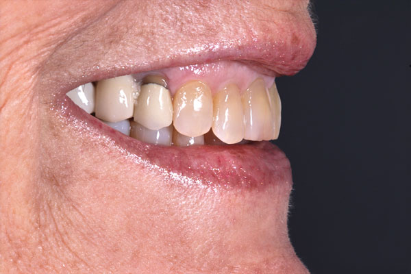 face-dentistry-after After FACE Dentistry