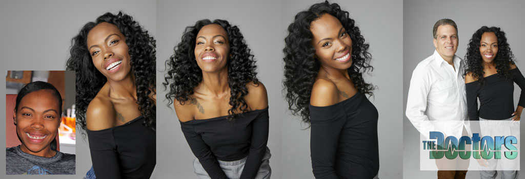 goodman-veneers-before-after Veneer Transformation