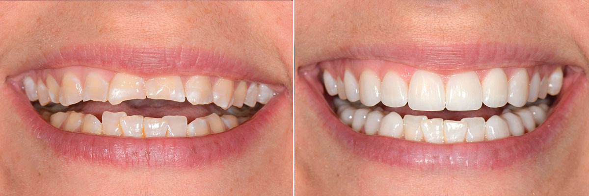 grinder-before-after Veneers for Short Teeth