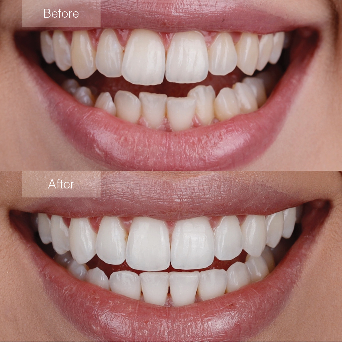 Before and After Invisalign by Blue Diamond Provider