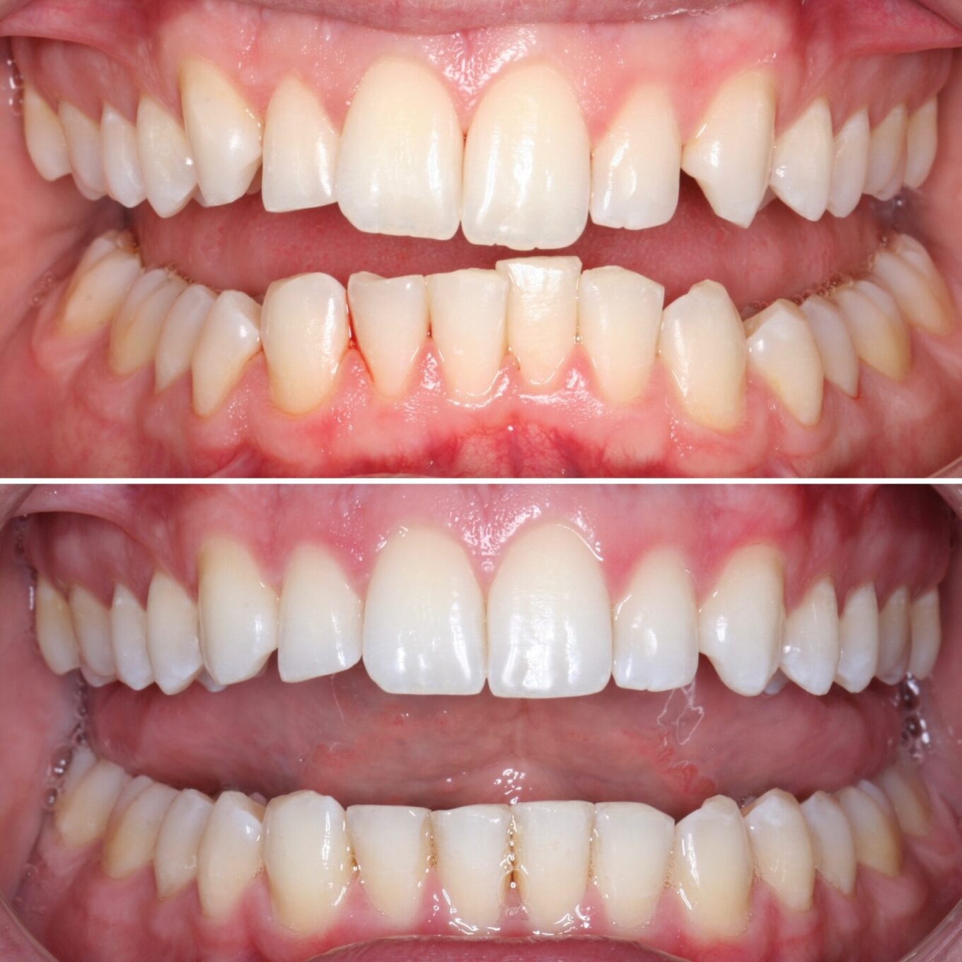 Invisalign by Dr. Joseph Goodman - Before and After