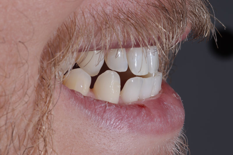 face-dentistry-after FACE Dentistry After Bite Correction