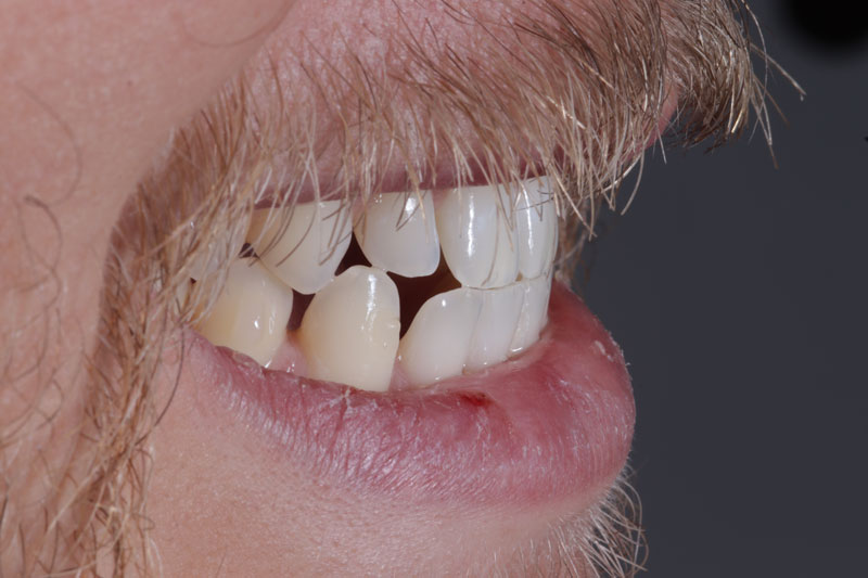 face-dentistry-before Face Dentistry Before Bite Correction