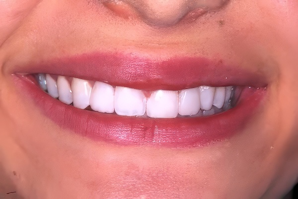 Invisalign closed gap between teeth