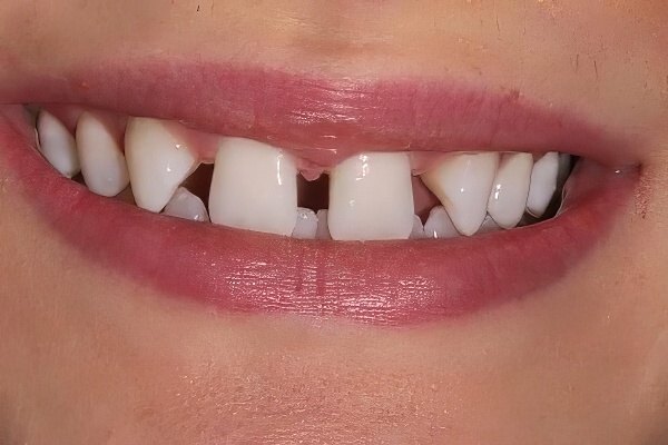 Invisalign to close gap between teeth