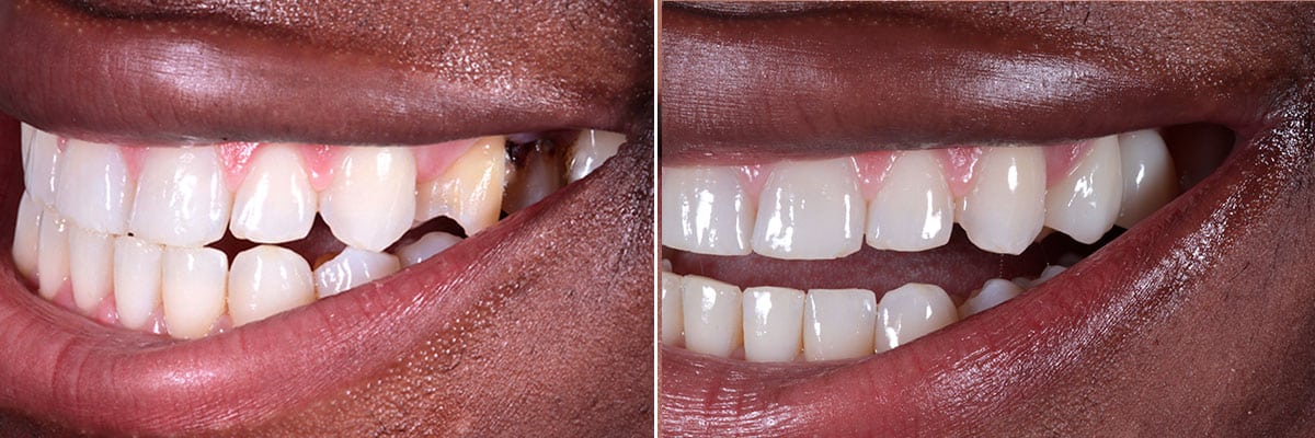 Invisalign - before and after impacted tooth corrected