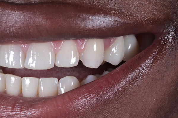 Invisalign - After