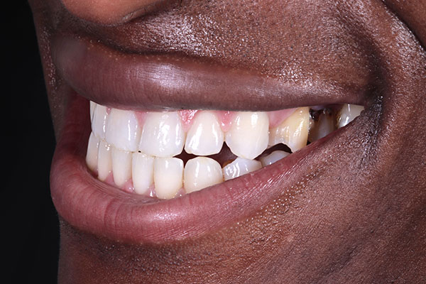 Invisalign - Before