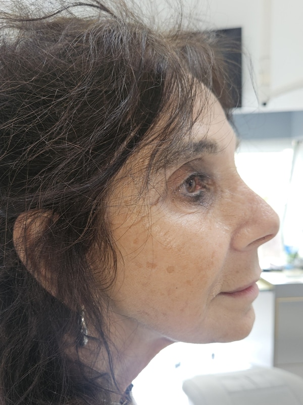 Non Surgical Small Chin Fix - After