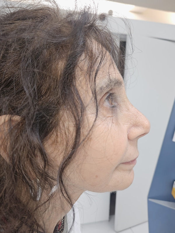 Non Surgical Small Chin Fix - Before