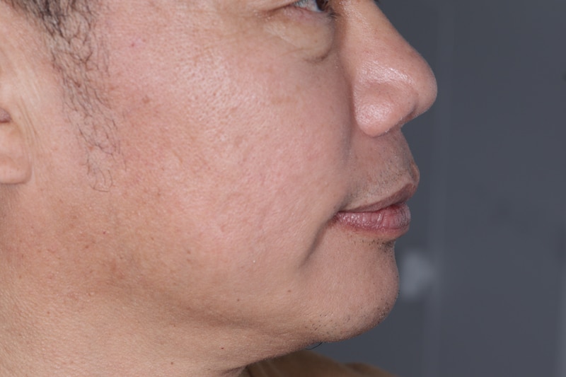 Improved Jaw and Chin Line