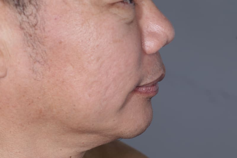 Jaw and Chin Line Correction - Before