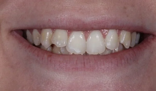 Veneers before picture