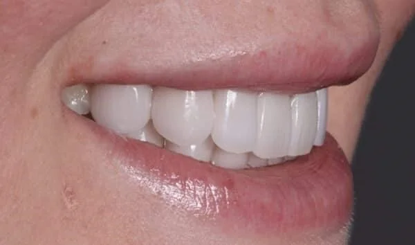 porcelain Veneers after picture