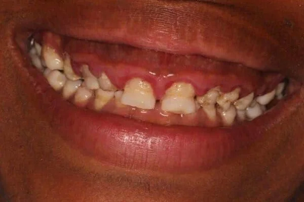 Veneers before picture