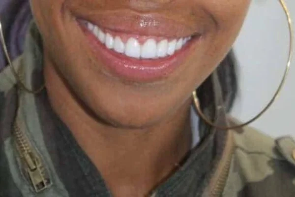 porcelain Veneers after picture